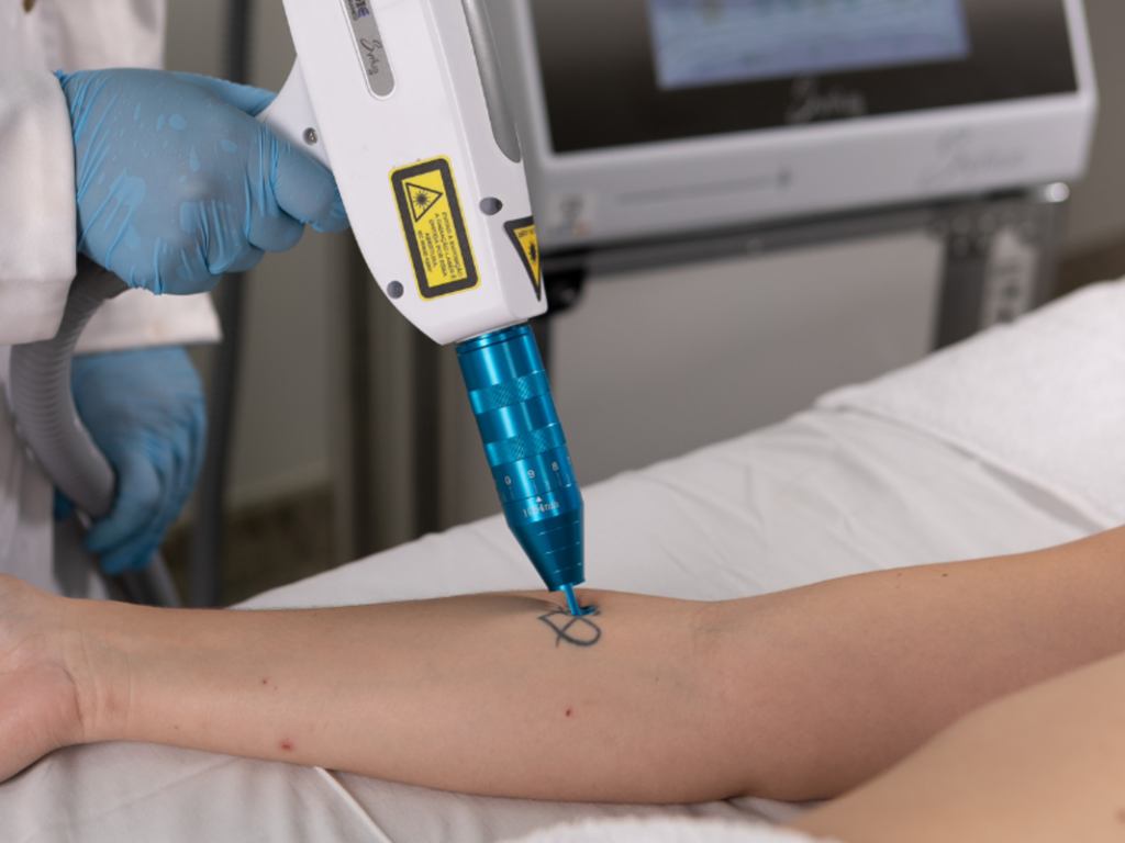Remoção de Tatuagem com Laser