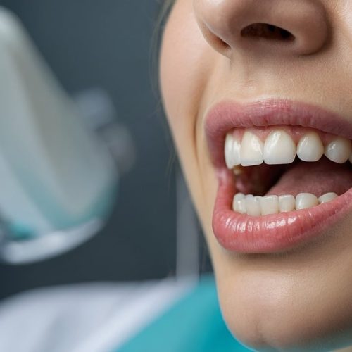 Clareamento dental com PAP reduz a sensibilidade e irritação