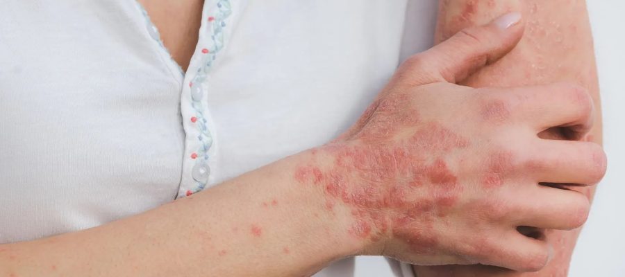 Conheça oito doenças típicas do verão e saiba como evitá-las