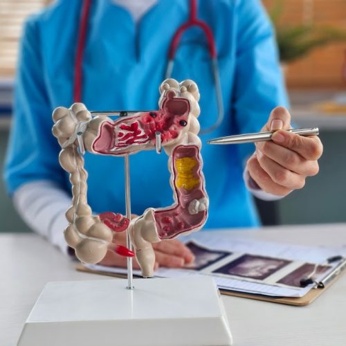 Idade é principal fator de risco para morte por câncer colorretal